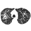 Tomografias do tórax com imagens de algumas das alterações pulmonares difusas.