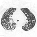 Uma radiografia e uma tomografia do tórax com imagem de outras alterações pulmonares difusas.