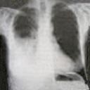 Radiografia do tórax com derrame pleural do lado esquerdo (cor branca).