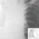 Radiografia do tórax com empiema do lado esquerdo.