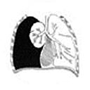 Quilotorax, em que o lado direito do pulmão encontra-se expandido e o lado esquerdo está colapsado (murcho). Visualiza-se a presença de líquido (em preto) no espaço pleural.